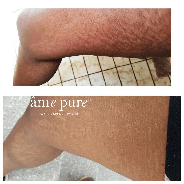 Comparaison avant-après des vergetures sur la jambe.