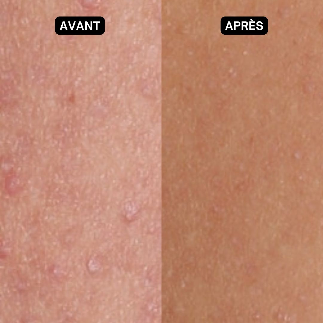 Comparaison de la peau : avant et après. Peau avec rougeurs et boutons. Après : peau lisse. Texte : « Avant » et « Après ».