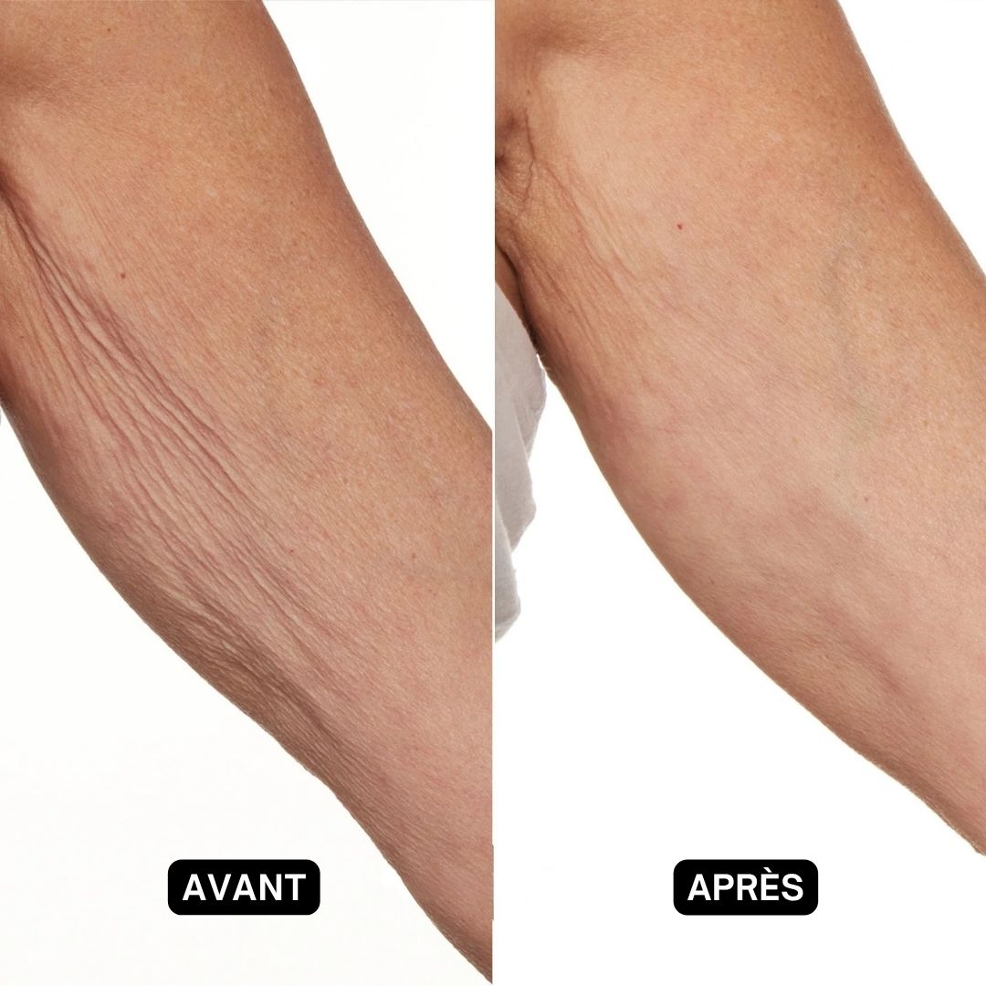 Comparaison avant-après de la peau sur un bras. Gauche : peau ridée. Droite : peau lisse.
