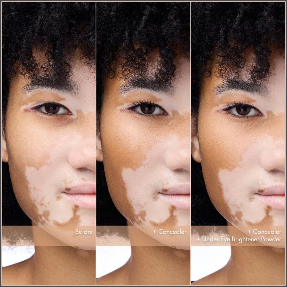 Visage atteint de vitiligo en trois sections : Avant, avec correcteur, avec correcteur et poudre fixatrice éclaircissante.