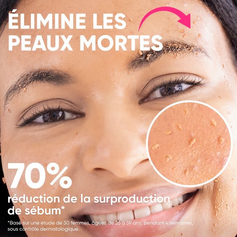 Gros plan d'une femme dont la peau montre des cellules mortes éliminées par le peeling "Peels So Good" âme pure.