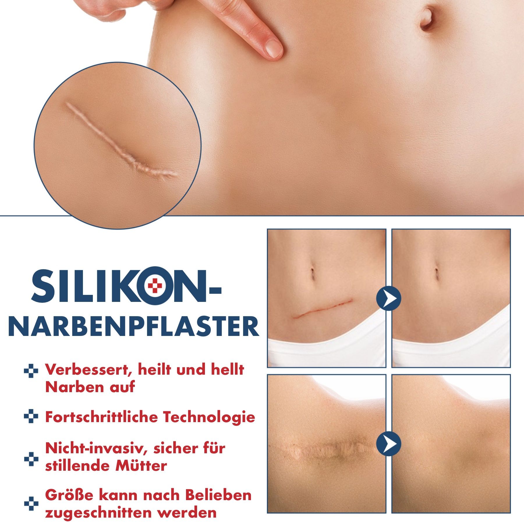 Close-up van een litteken op de buik. Tekst: Silikon-Narbenpflaster. Voor-en-na beelden tonen verbetering.