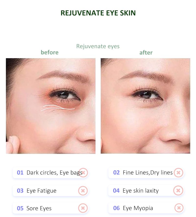 Comparaison avant-après des yeux. Montre des améliorations des cernes, des poches et des rides.