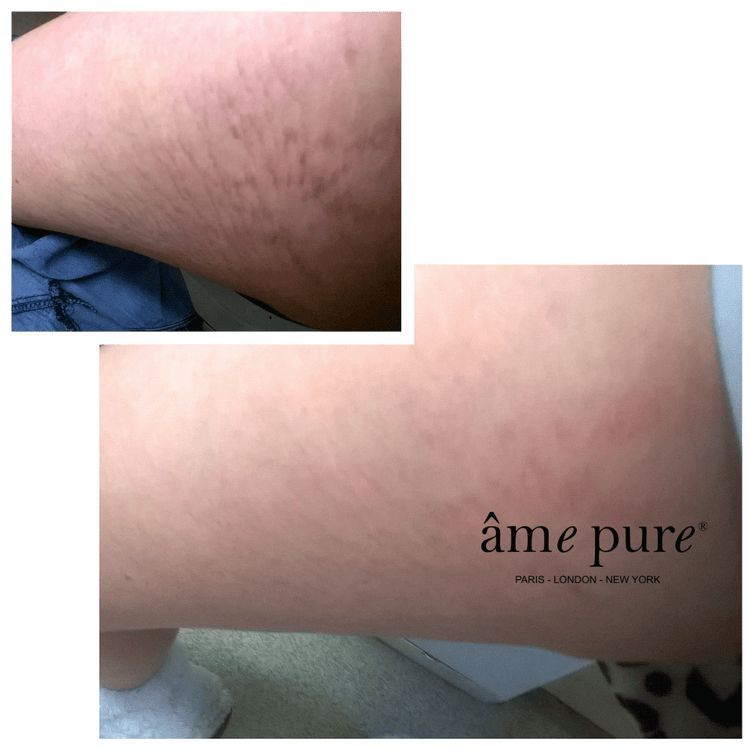 Comparaison avant-après des vergetures sur la cuisse.