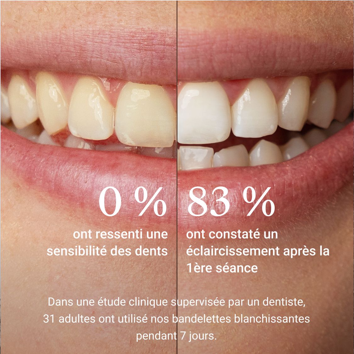Comparaison des dents avant et après les bandes blanchissantes. Texte: 0% sensibilité, 83% éclaircissement.
