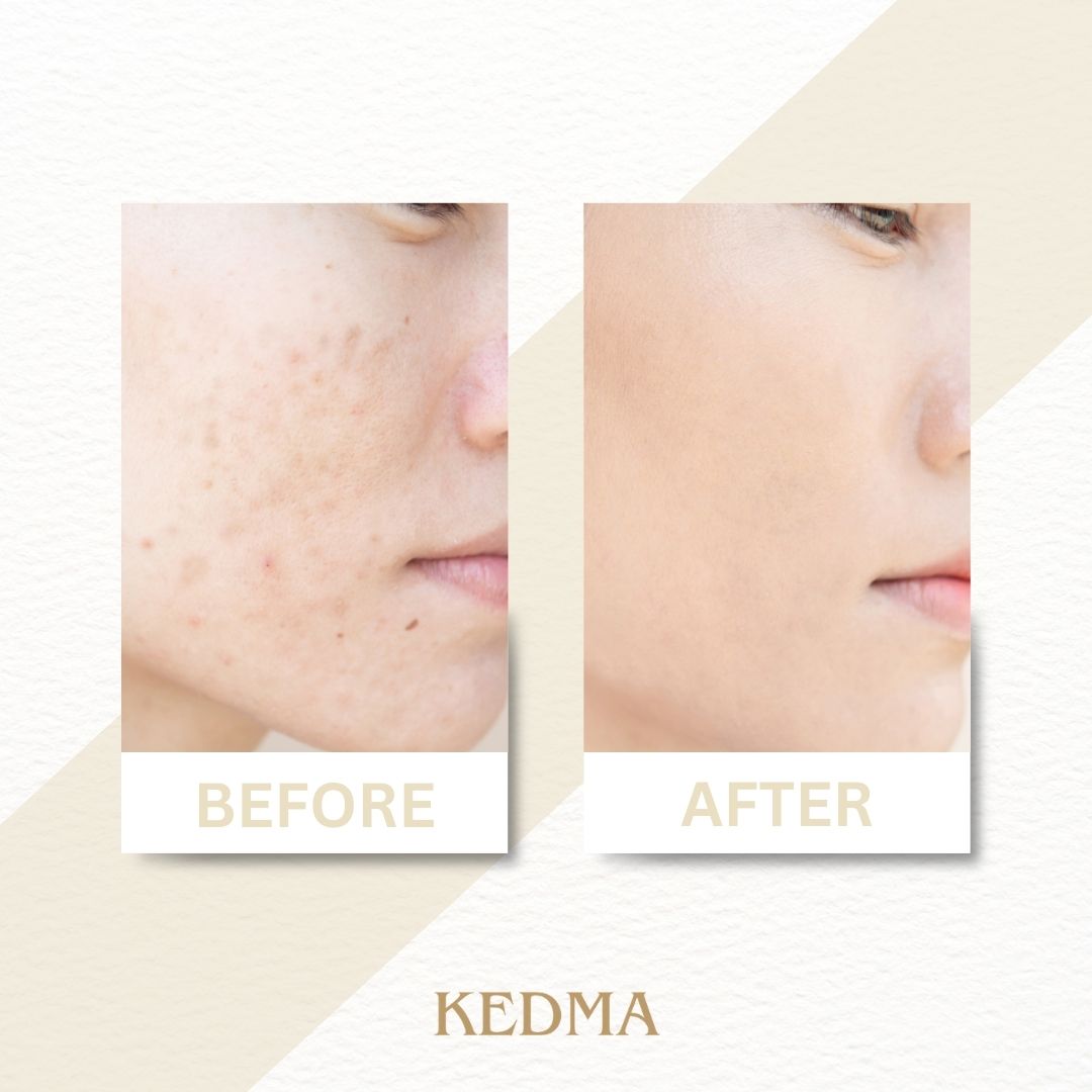 Kedma - Peeling Exfoliant pour le Visage aux Extraits de Fruits