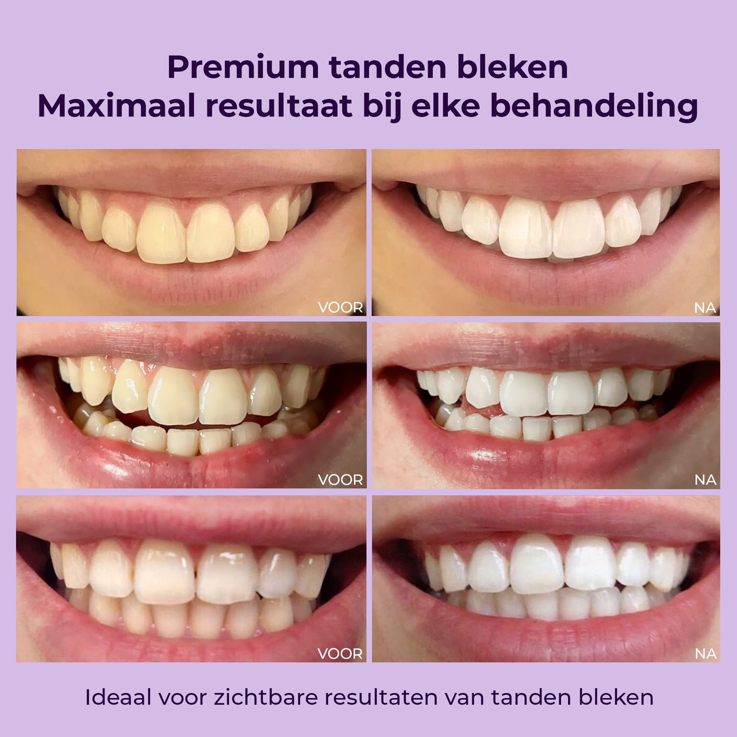 Voor- en na-vergelijking van tanden. Meerdere rijen tonen bleekresultaten.