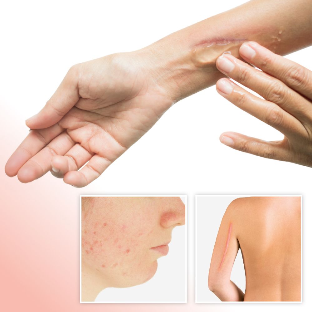Personne appliquant du gel sur une cicatrice au poignet. Deux petites images: peau acnéique, cicatrice dans le dos.