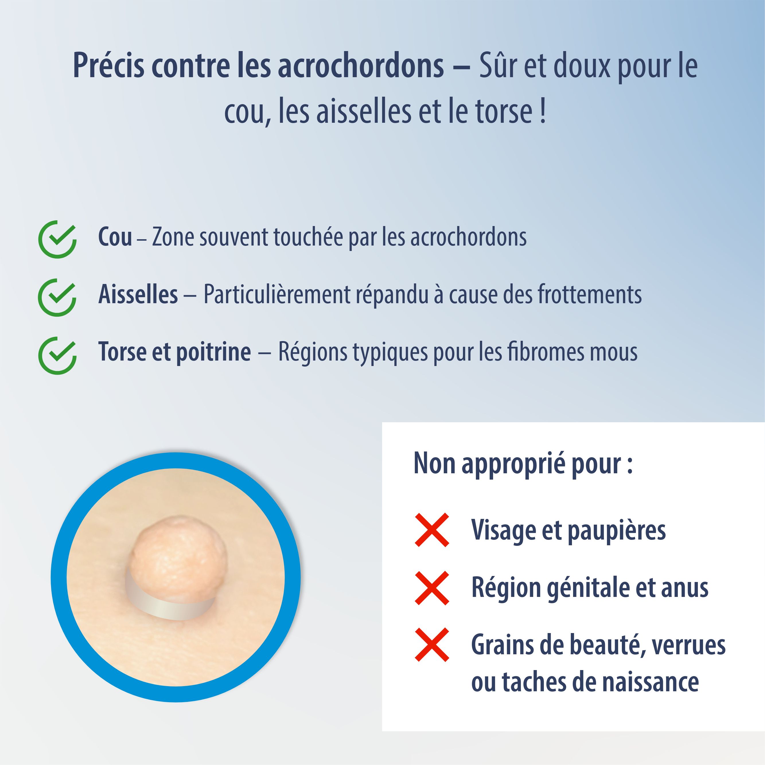 Evolsin Anti Stielwarze : Étapes d'application avec technologie d'anneau en silicone.