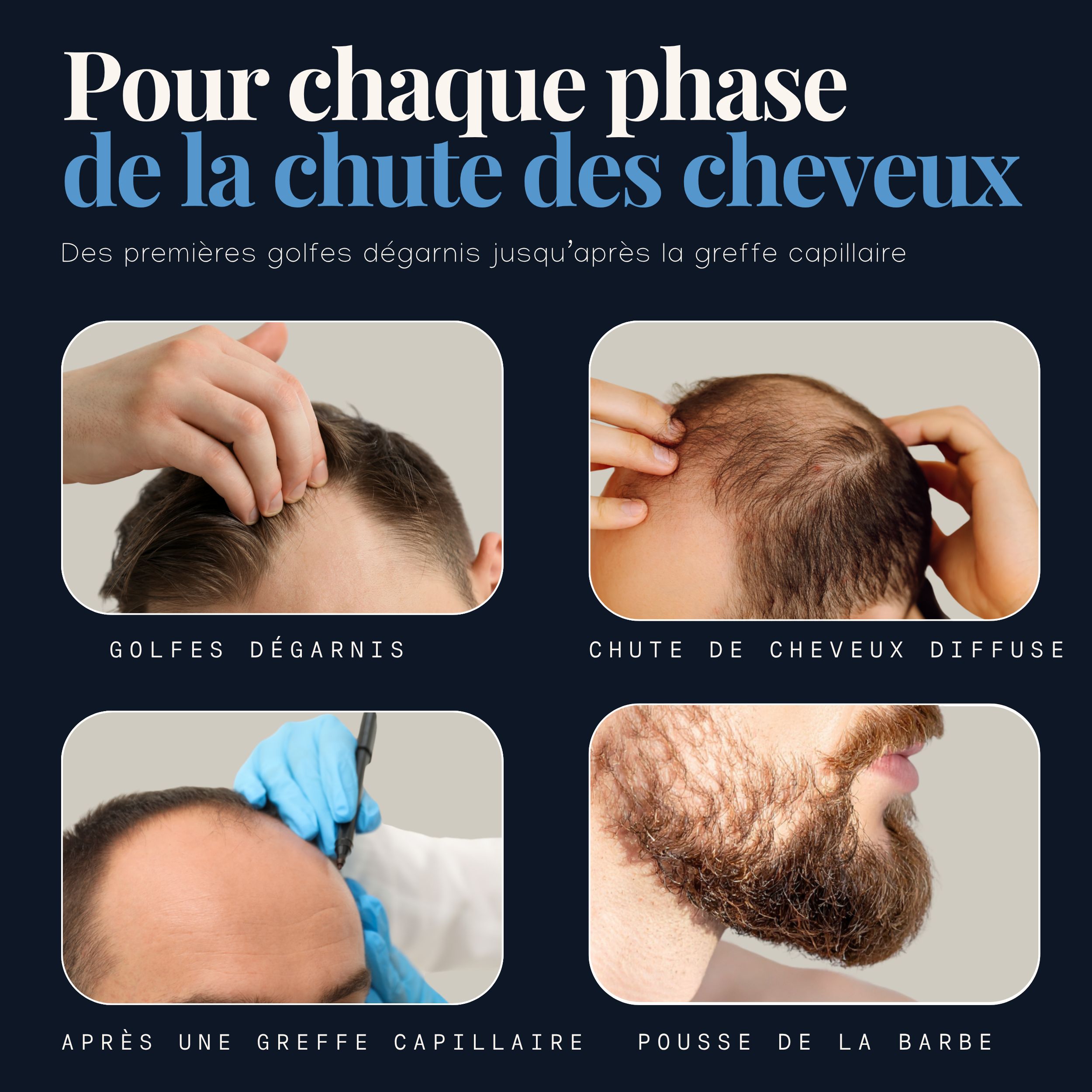 Hairforte Spray 3% Procapil contre la perte de cheveux, bloqueur de DHT