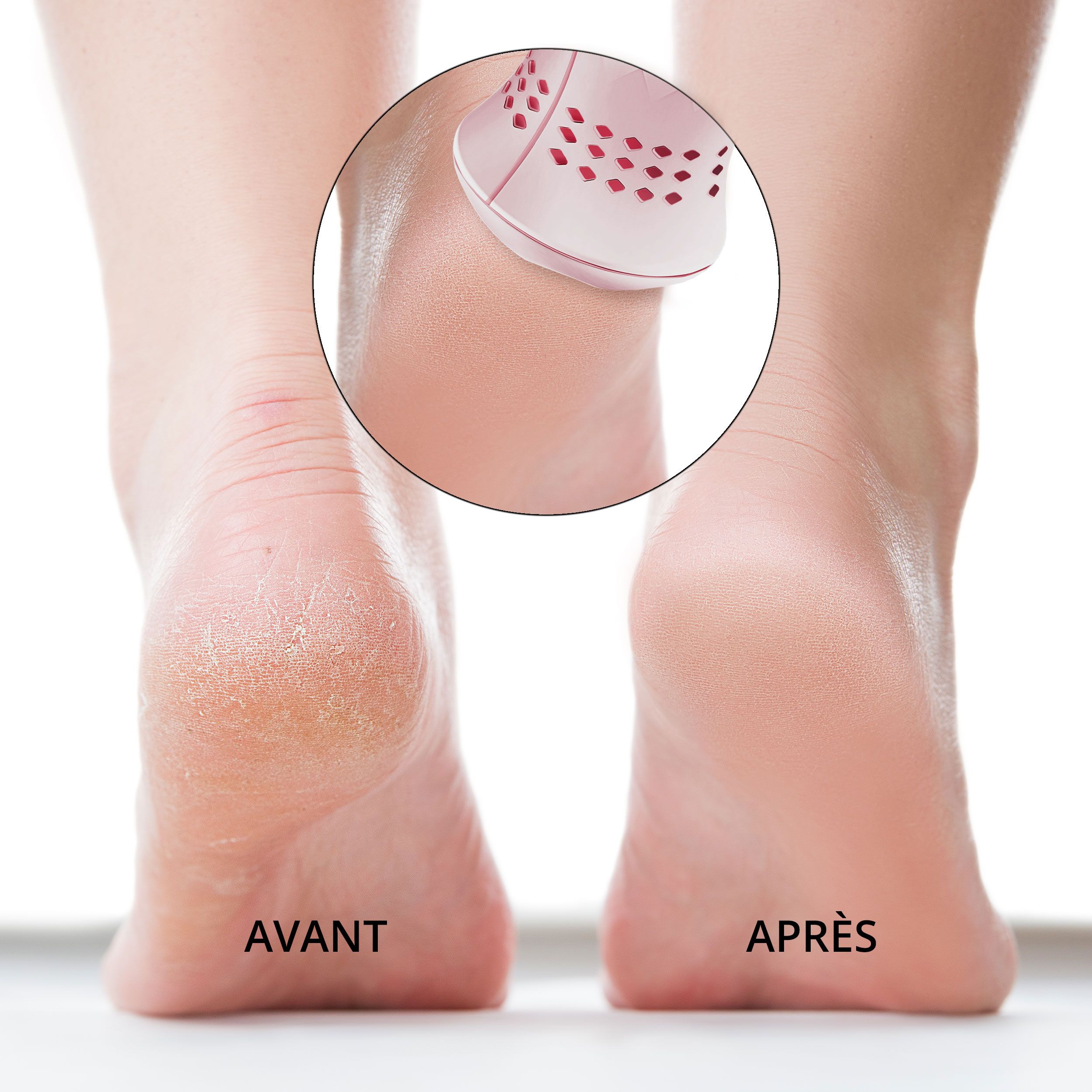 Pieds avant et après utilisation. En cercle: appareil. Texte: AVANT et APRÈS.