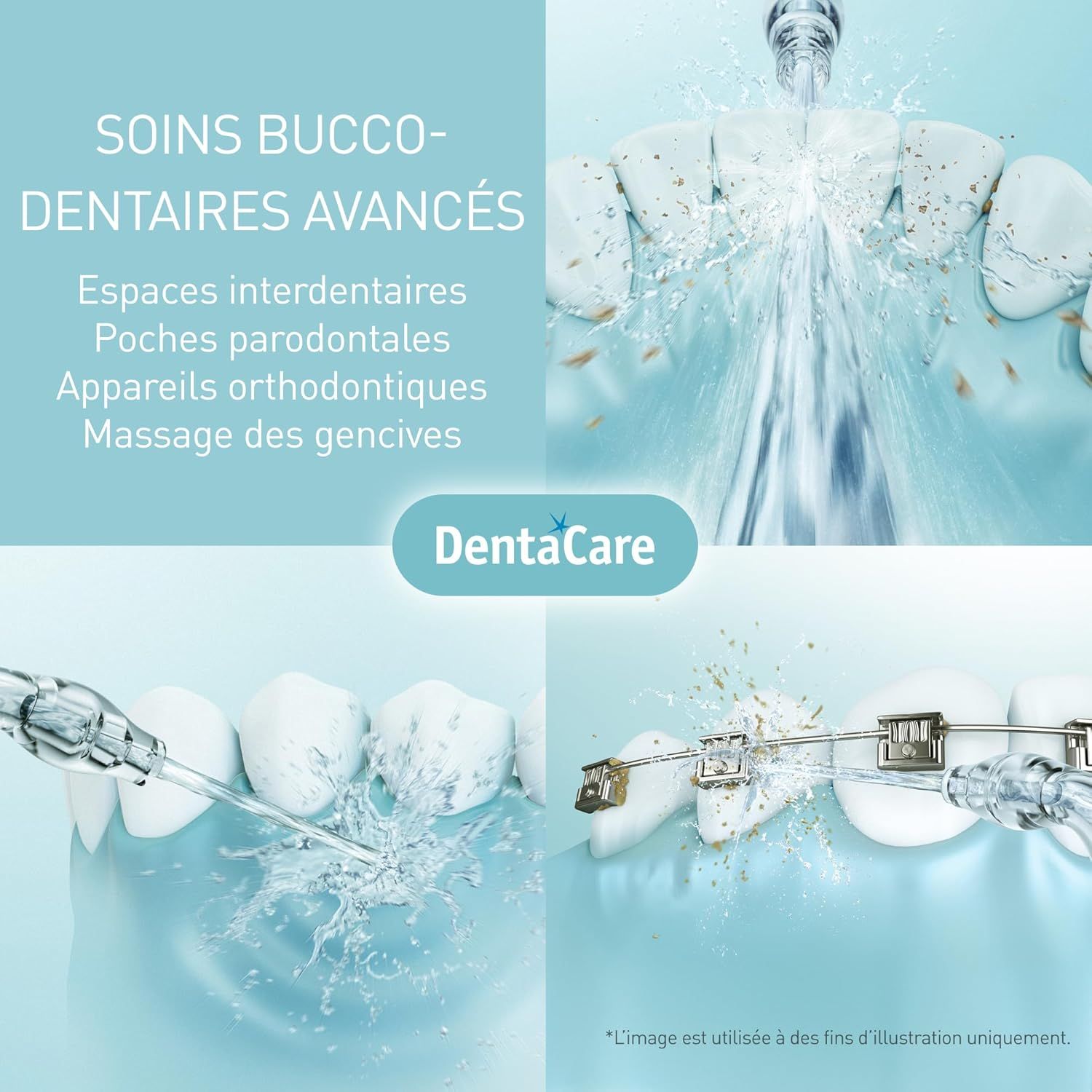 Soins bucco-dentaires avancés: nettoyage des espaces interdentaires, poches parodontales.