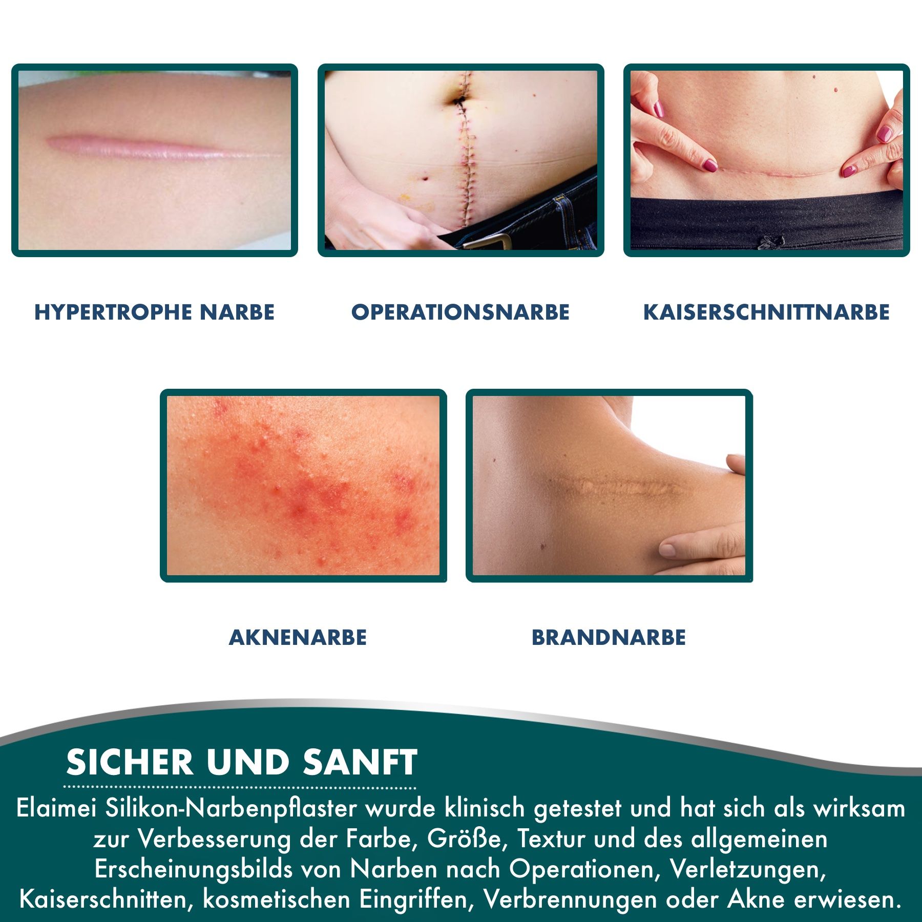 Verschillende soorten littekens: hypertrofisch litteken, operatie litteken, keizersnede litteken, acne littekens, brandwond litteken. Tekst: Veilig en zacht.
