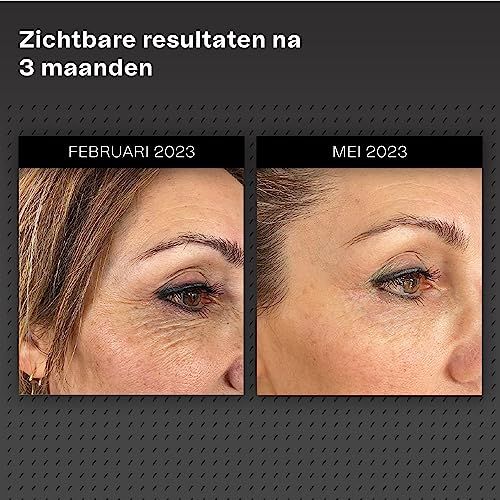 Vrouw houdt microneedling-apparaat vast. Tekst: Alles voor je huid in 1 box. Voor anti-aging en huidverbetering.