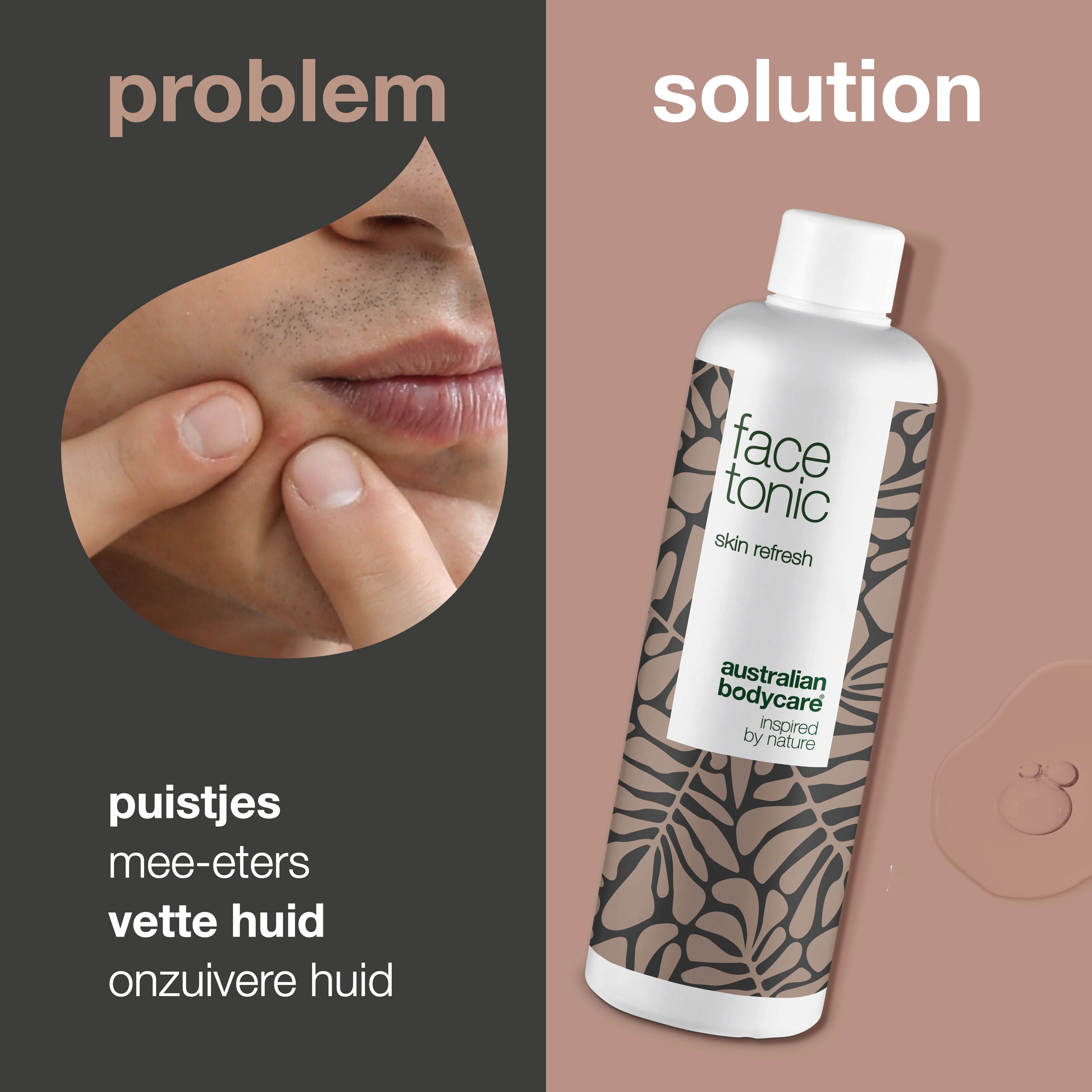 Gezicht met puistje. Rechts: fles "face tonic" van Australian Bodycare. Tekst: puistjes, mee-eters, vette huid, onzuivere huid.