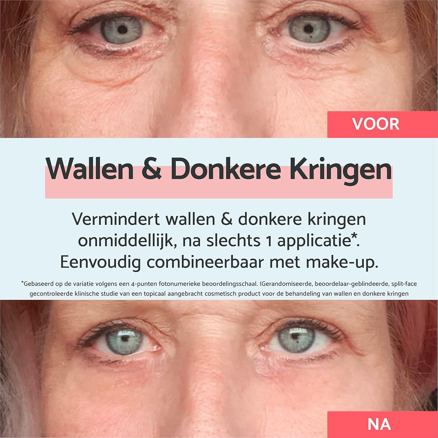 Voor-en-na vergelijking van de oogzone: vermindering van wallen en donkere kringen.