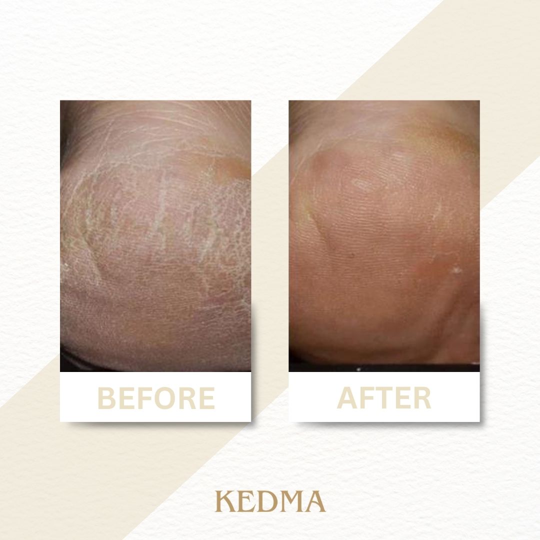 Kedma - Crème Pieds aux Minéraux de la Mer Morte