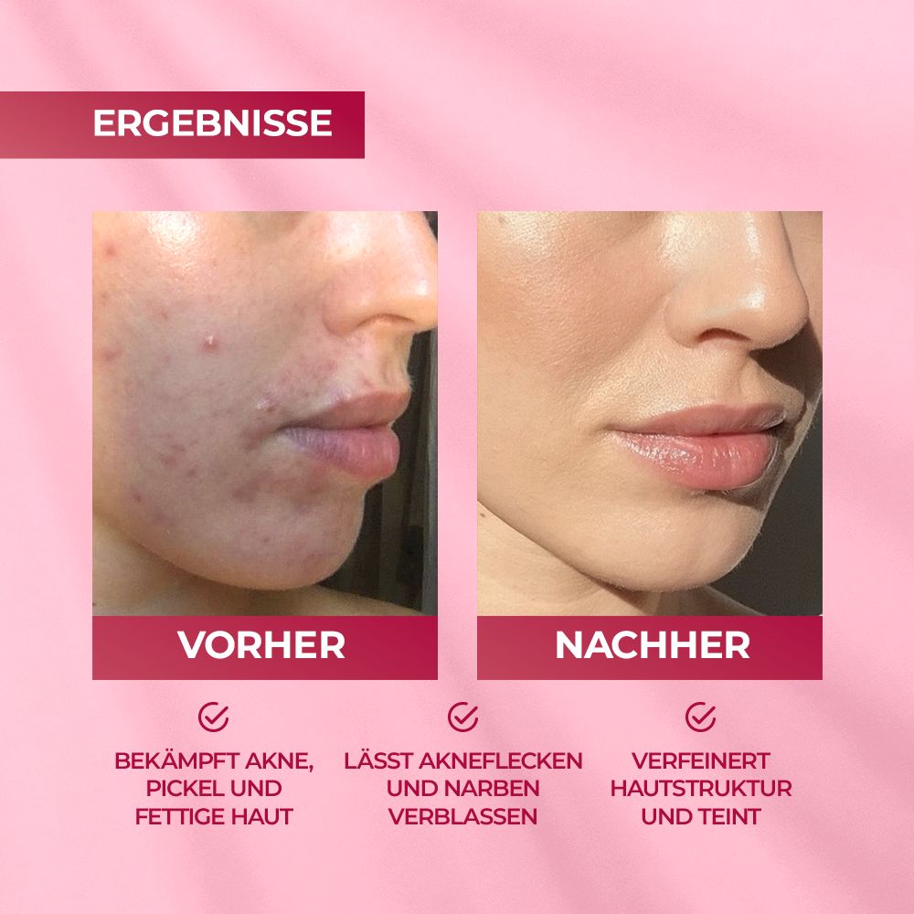 Comparaison avant-après. Visage acnéique avant traitement et peau améliorée après. Fond rose.