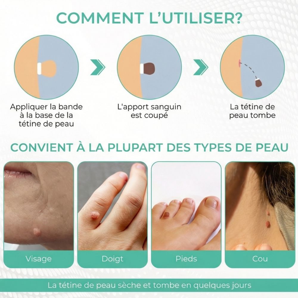 Illustration de l'utilisation. Excroissances cutanées sur visage, doigts, pieds et cou. Séchage et chute.