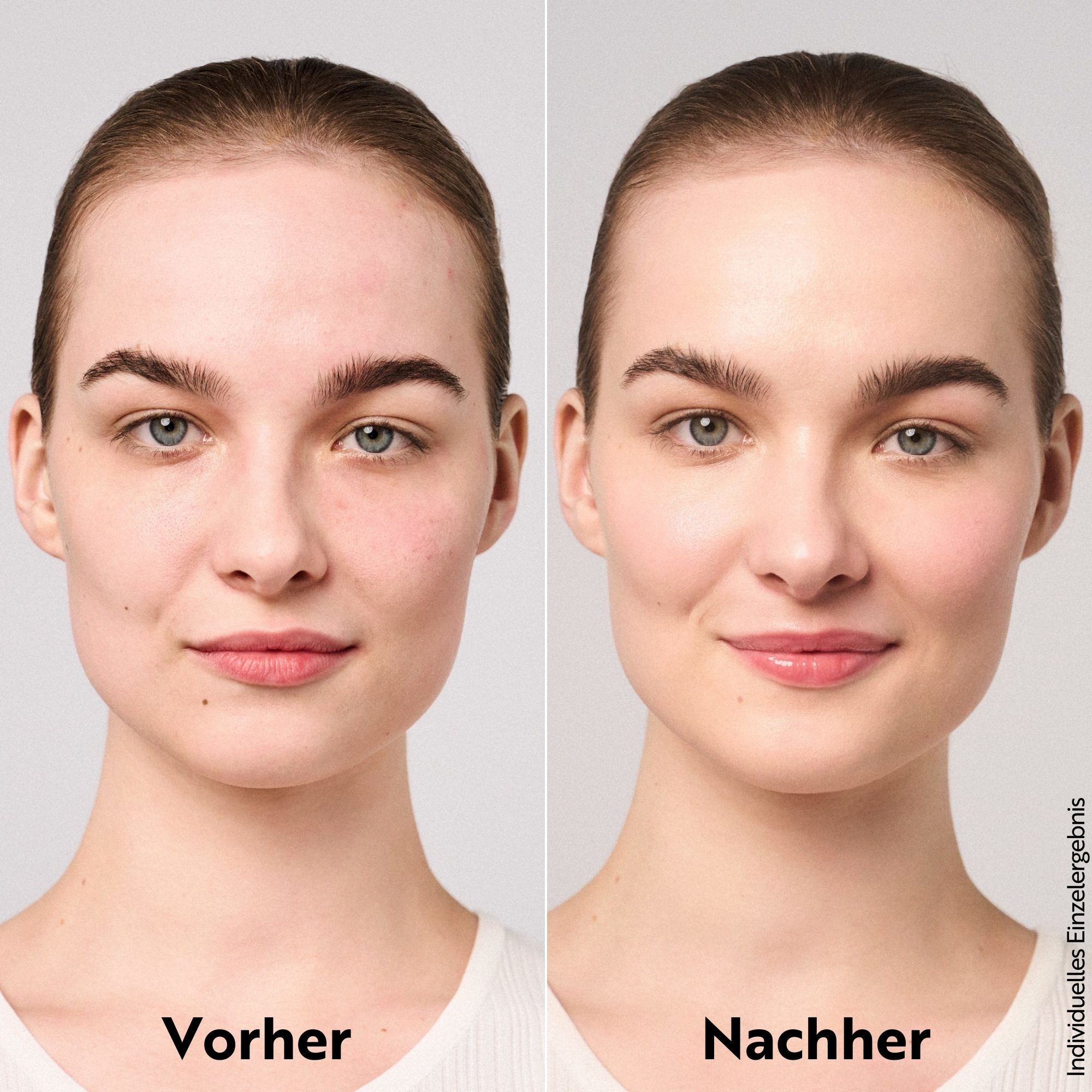 Voor-na vergelijking. Vrouw met huidonzuiverheden links, gladde huid rechts. Tekst: Voor, Na.