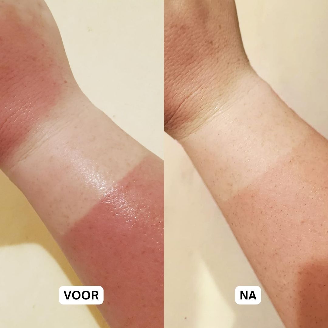 Twee armen. Links: door de zon verbrande huid. Rechts: huid na gebruik. Tekst: Voor, Na.