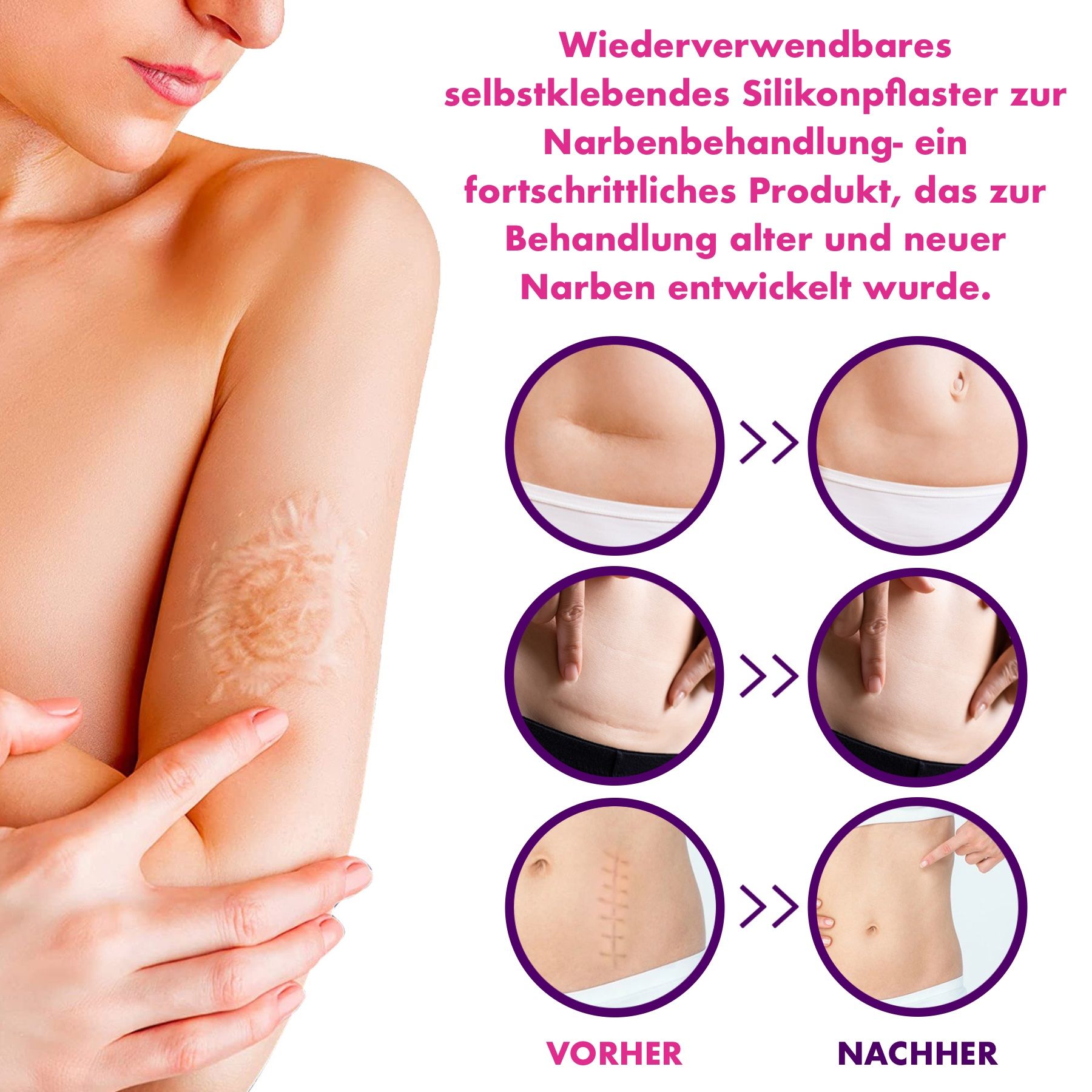 Illustratie: vrouw met littekens op arm en buik. Voor-en-na vergelijking van littekenbehandeling.