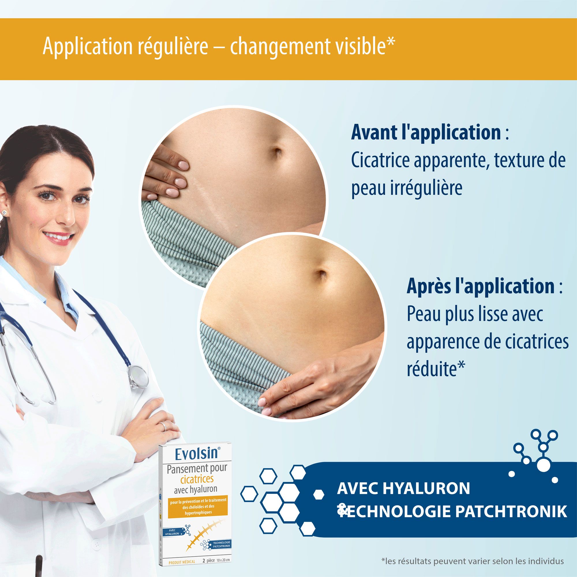 Evolsin® Pansements cicatriciels avec acide hyaluronique – pour cicatrices opératoires, césarienne,