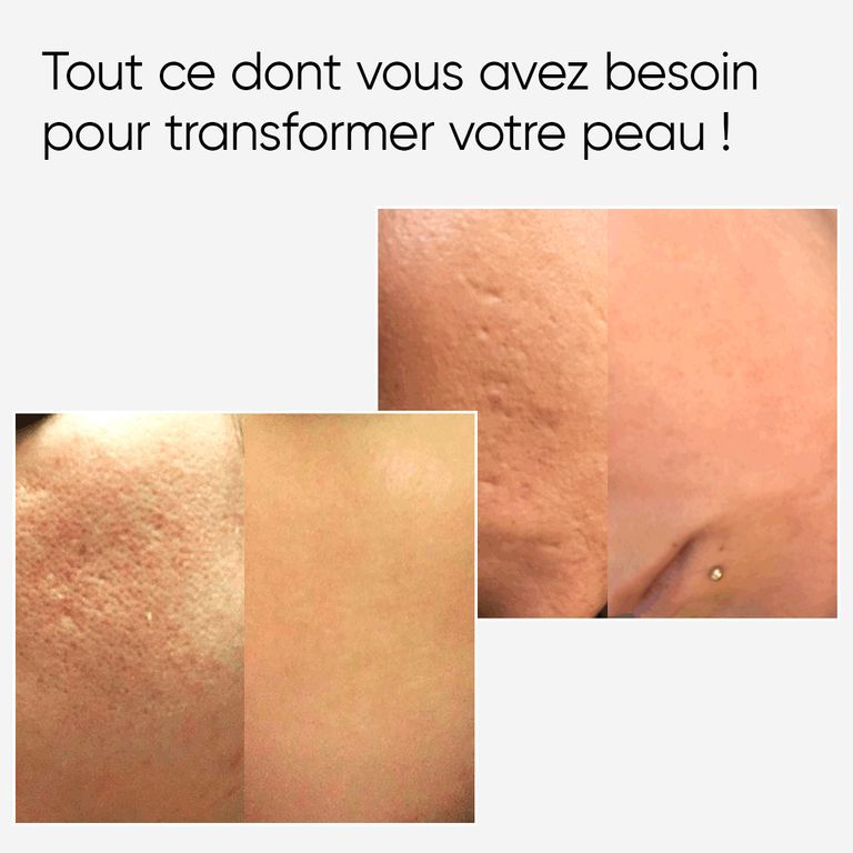 Images avant-après de textures de peau montrant des cicatrices et une peau améliorée.