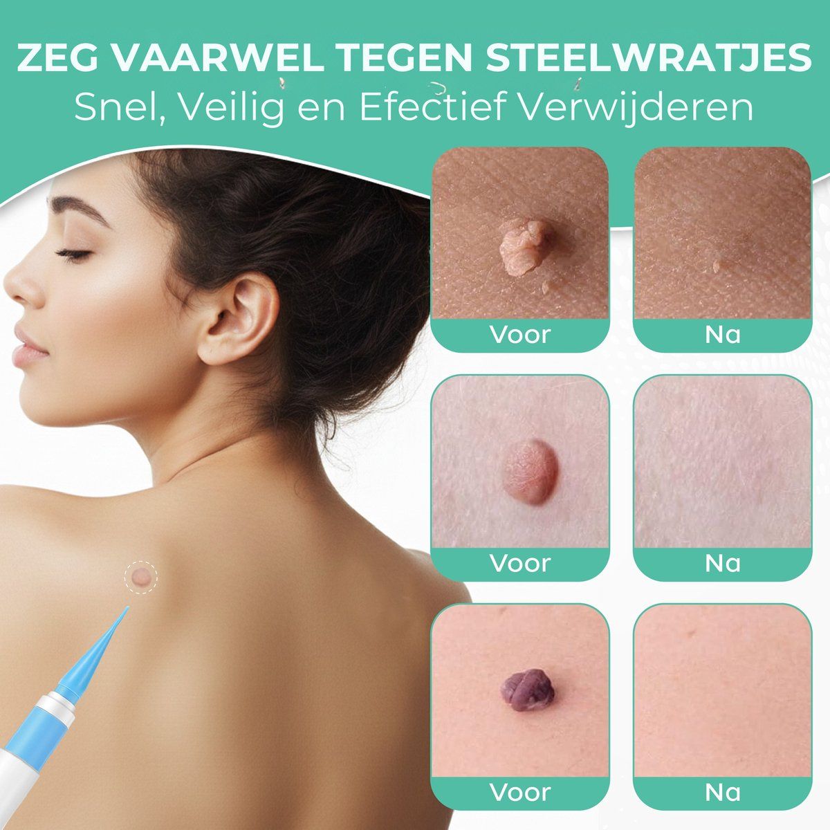 Voor- en na-afbeeldingen van huidlabels. Verwijdering met pen. Vrouw met huidlabel op rug.