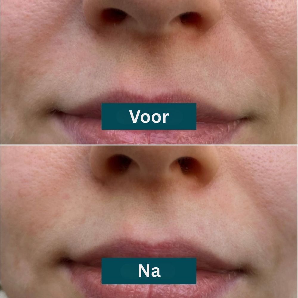 Voor-en-na vergelijking. Mondgebied met rimpels. Boven: Voor. Onder: Na. Gladdere huid.