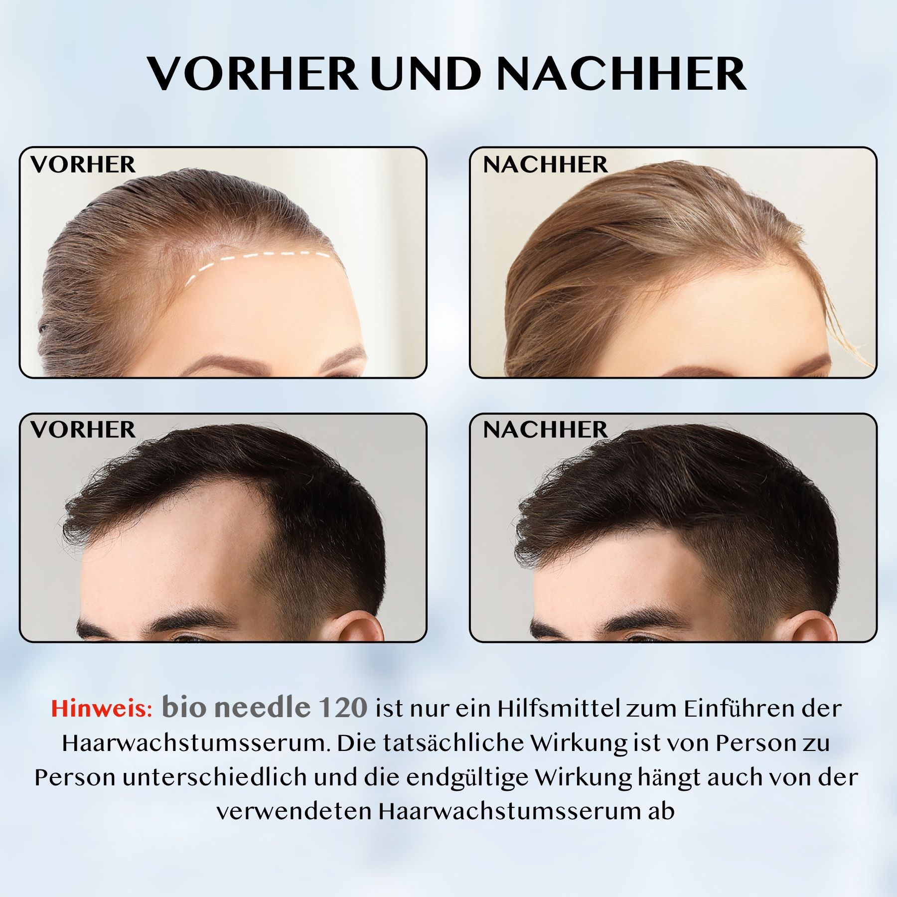 Voor-en-na vergelijking van haargroei bij vrouwen en mannen.
