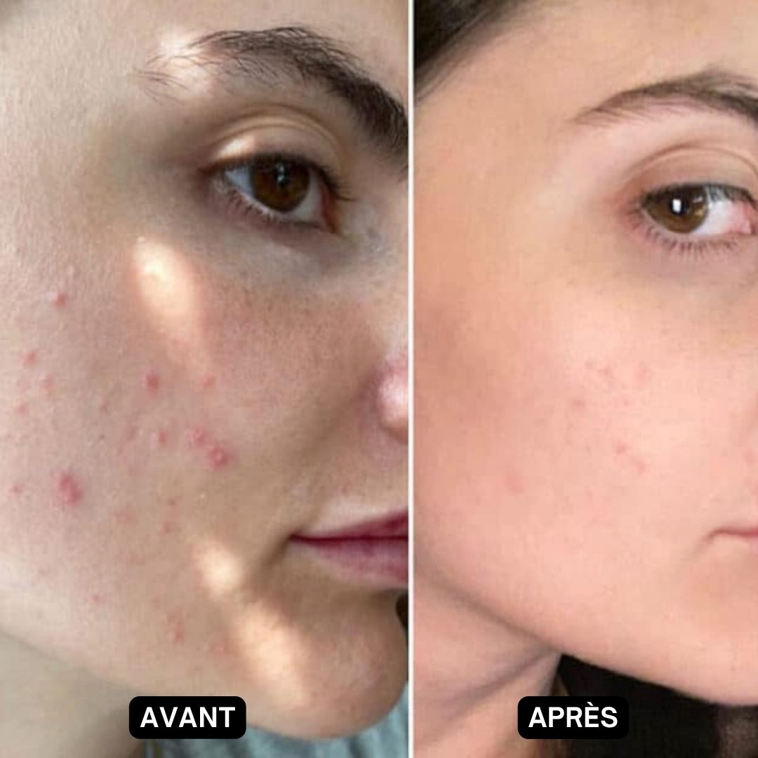 Comparaison avant-après. Visage avec acné avant et après le traitement.