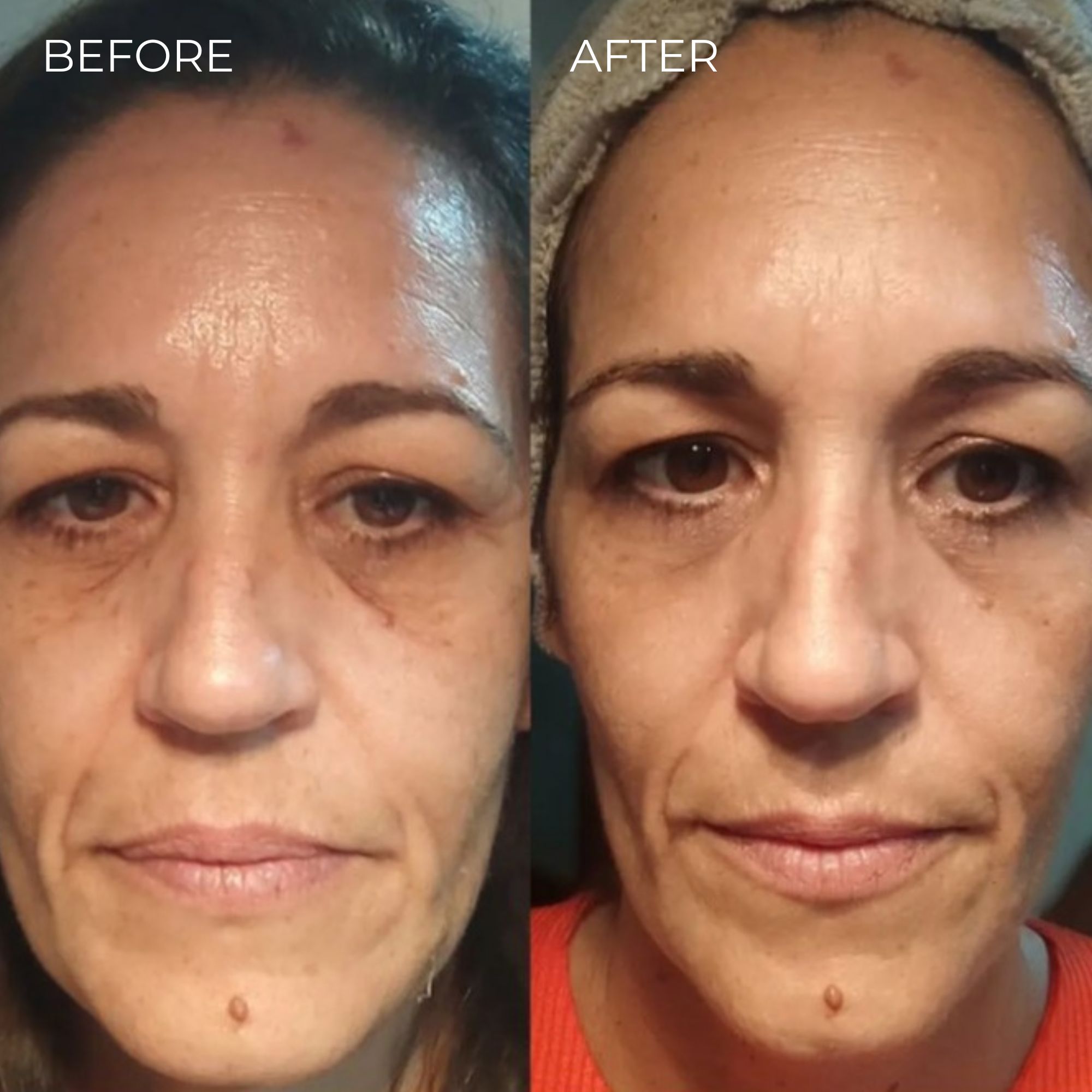 Comparaison avant-après. Visage ridé avant. Peau plus lisse après.