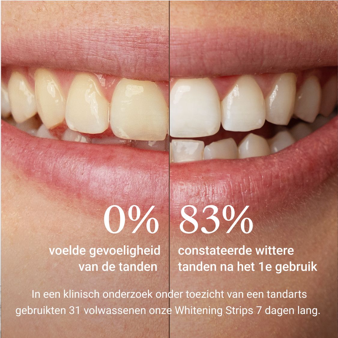 Vergelijking: tanden voor en na gebruik. 0% vs. 83% witter.