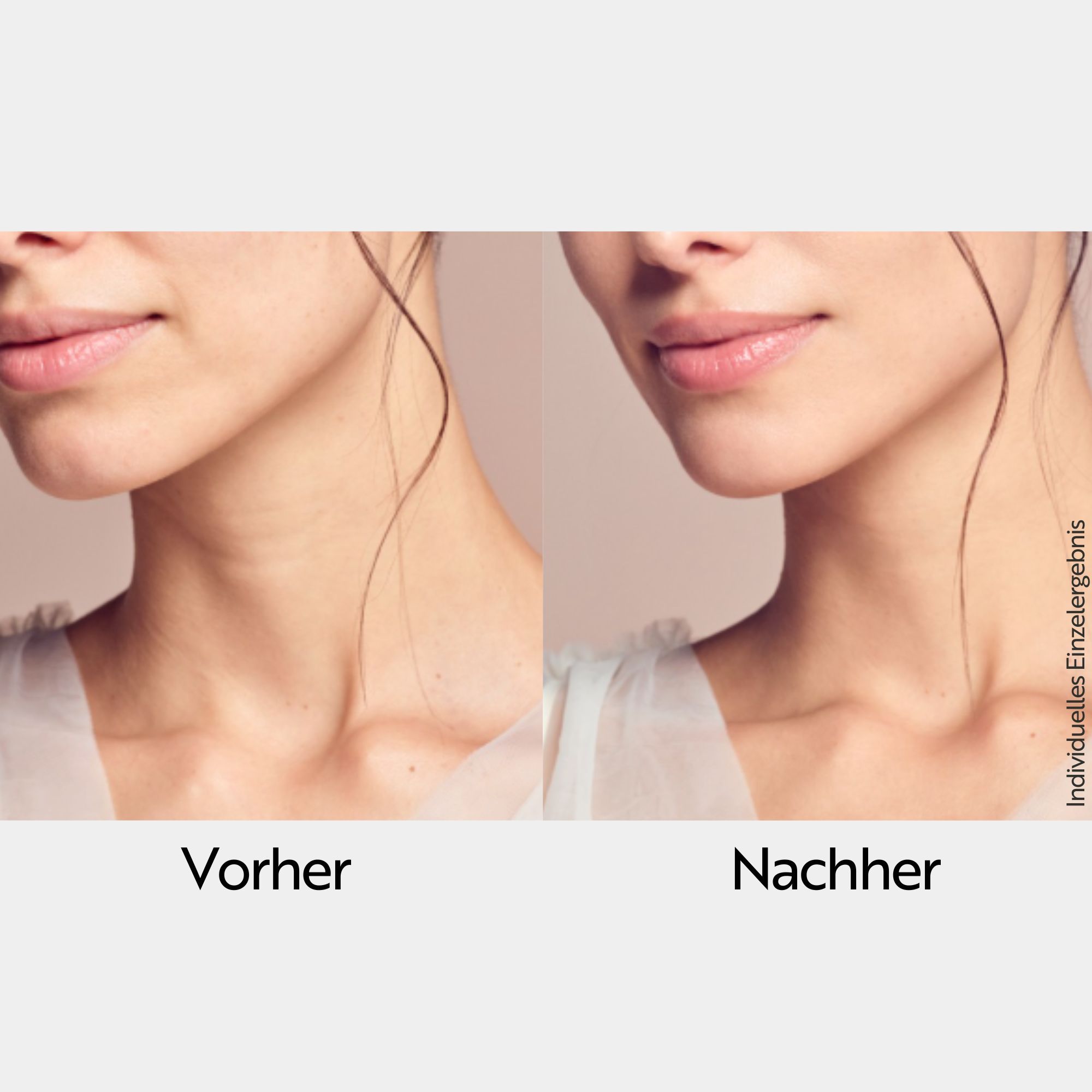 Comparaison avant-après. Cou et menton d'une femme. Gauche : Avant. Droite : Après.