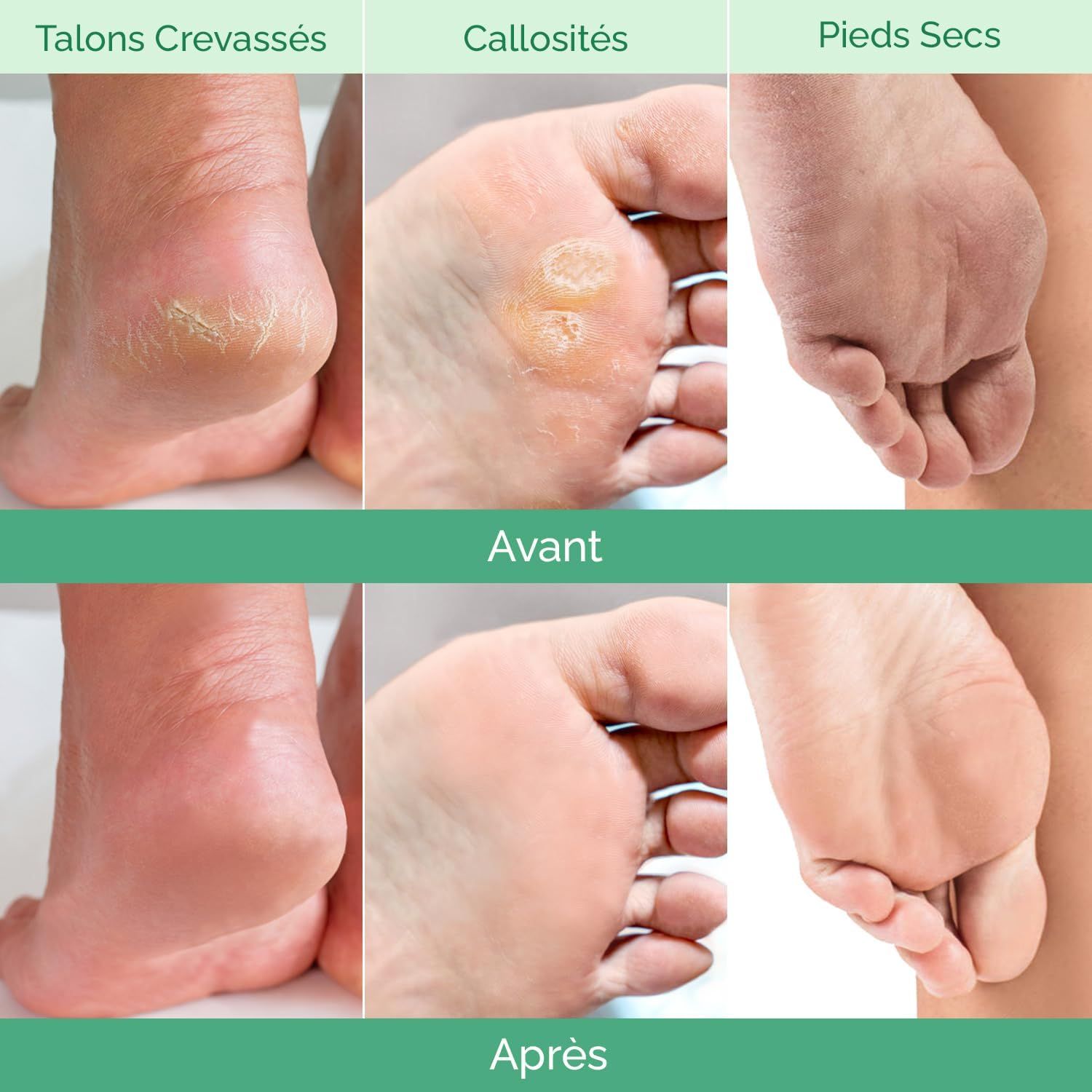 Avant : Talons crevassés avec peau sèche et squameuse.