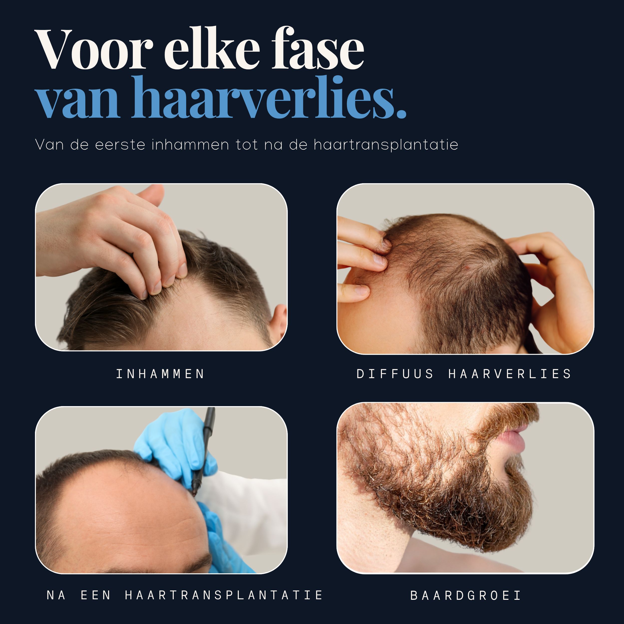 Hairforte Spray 3% Procapil tegen haarverlies, DHT-blokker