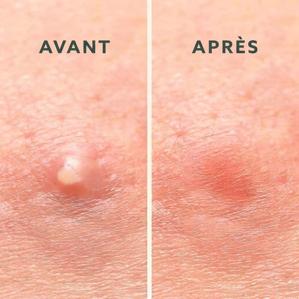 Comparaison avant-après de peau acnéique. Gauche : pustule enflammée. Droite : rougeur et gonflement réduits.