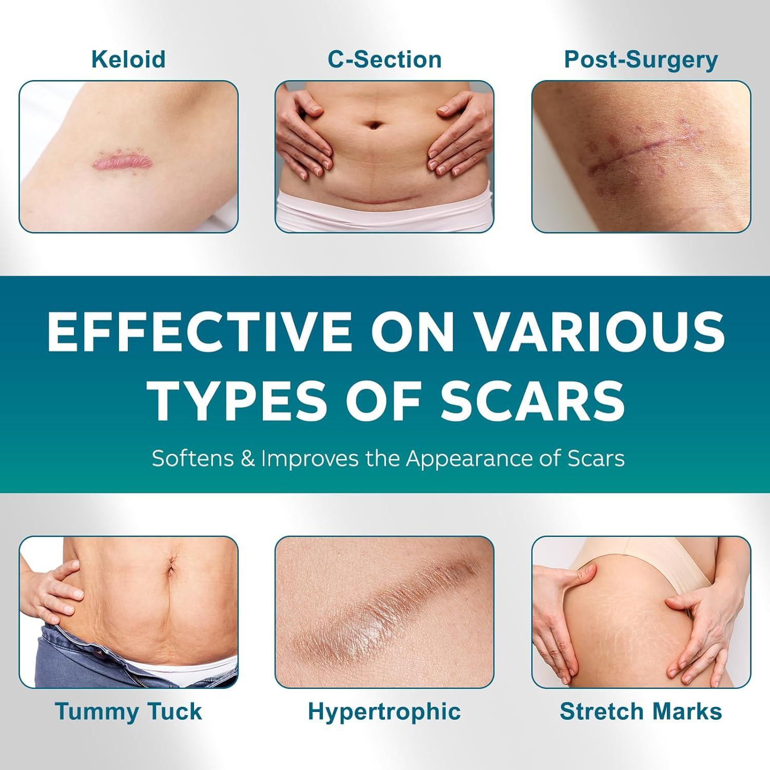Afbeeldingen van verschillende soorten littekens: keloïd, keizersnede, postoperatief, buikwandcorrectie, hypertrofisch, striae.