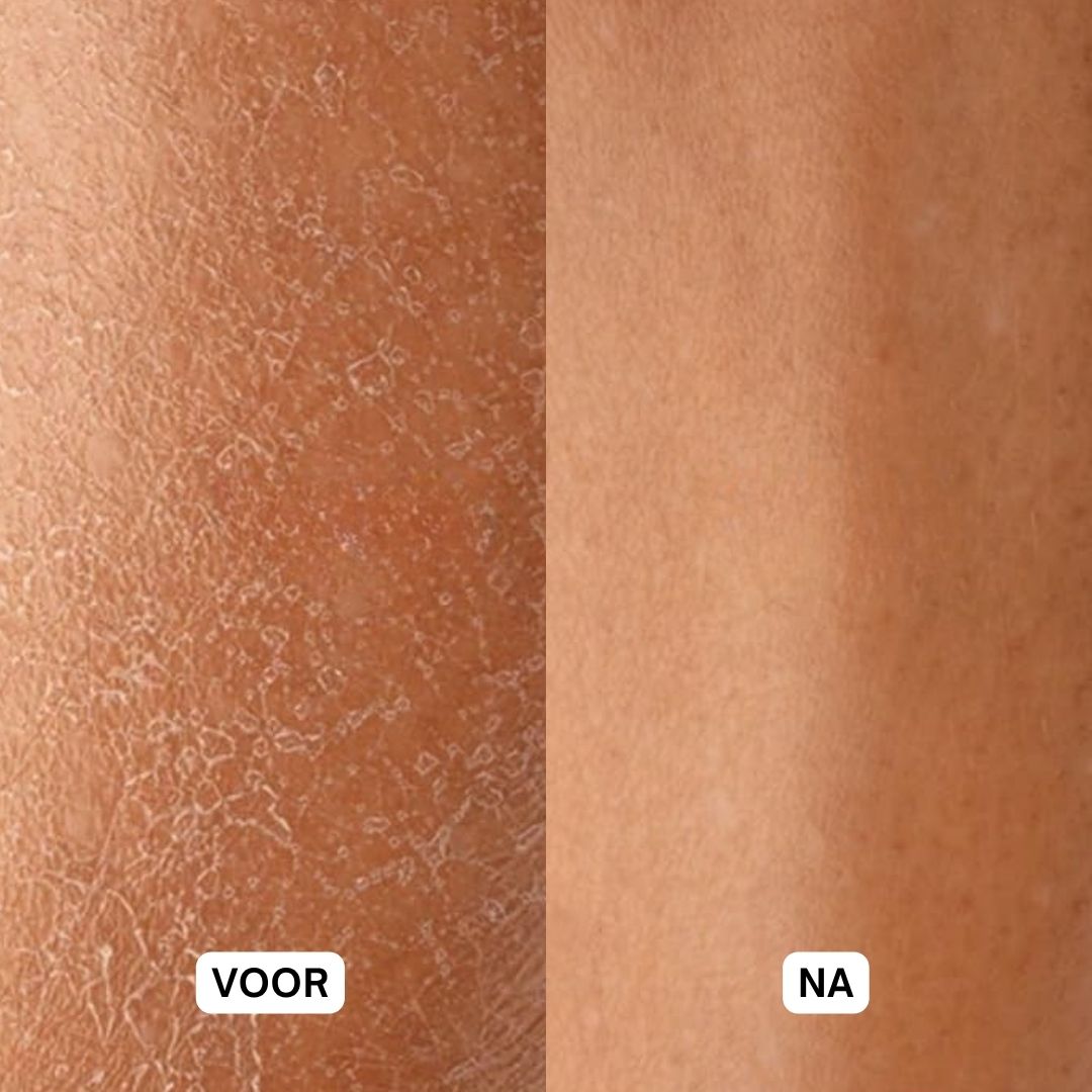 Voor- en na-vergelijking. Droge huid voor gebruik. Gladde huid na gebruik.