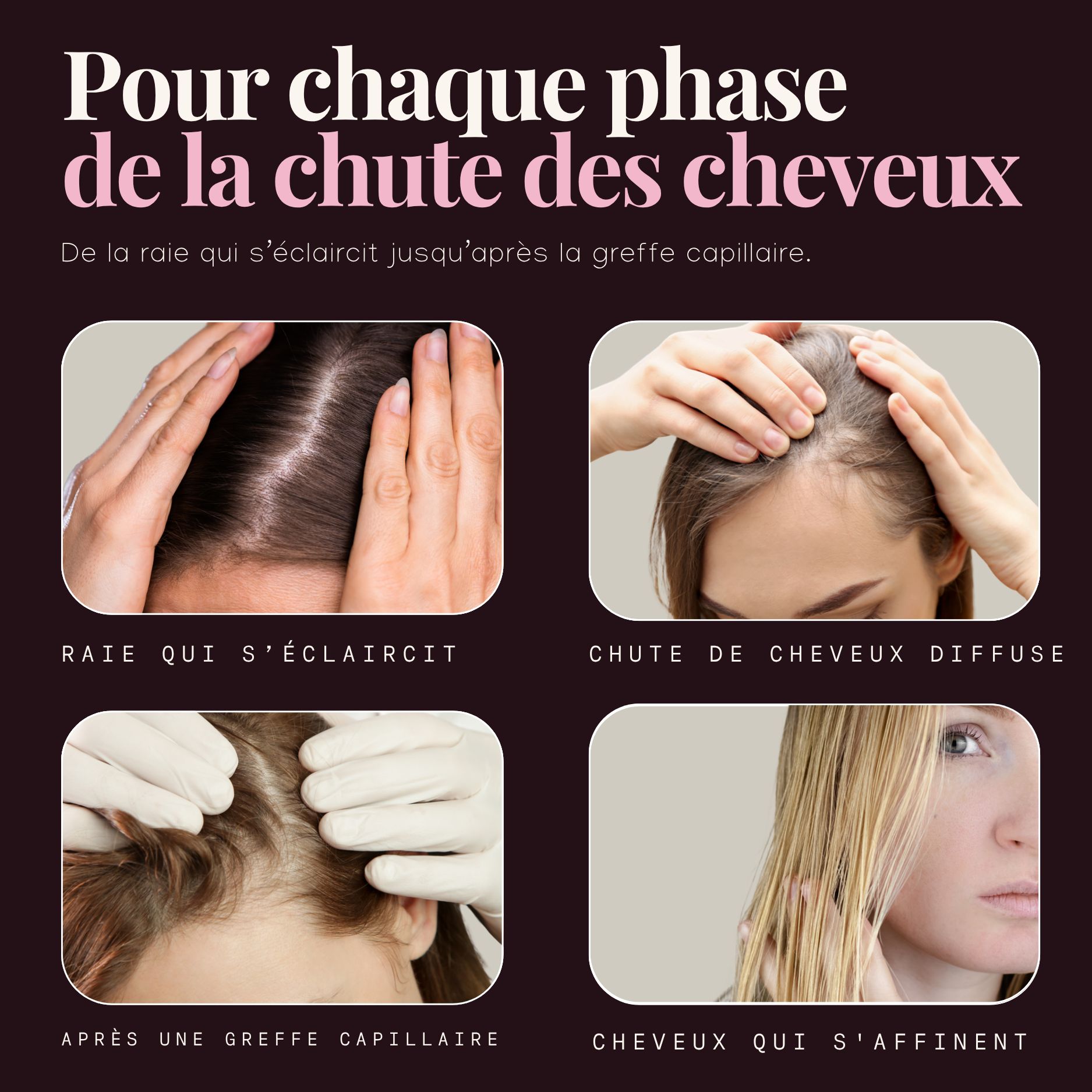 Quatre phases de perte de cheveux : raie qui s'éclaircit, perte diffuse, après greffe, cheveux qui s'affinent.
