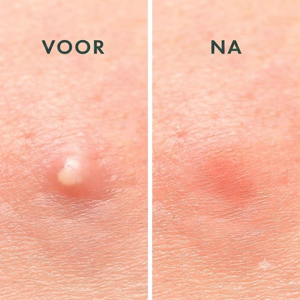 Close-up van huid met een ontstoken puistje (links) en verminderde roodheid (rechts).
