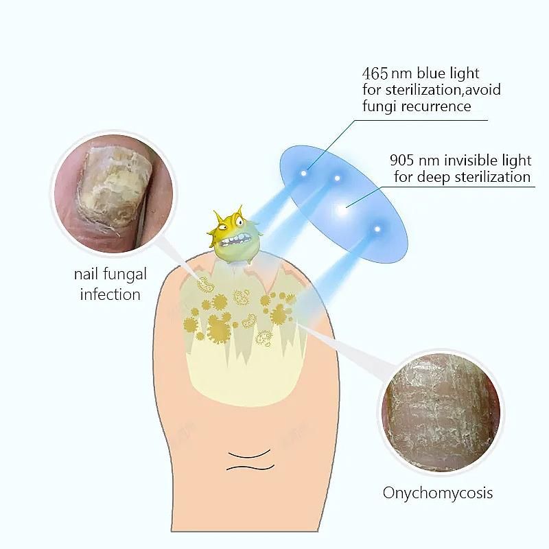 Illustratie: nagel met schimmelinfectie, behandeling met blauw en onzichtbaar licht.
