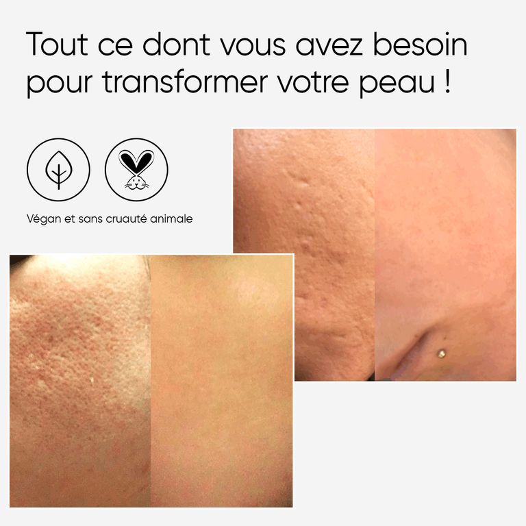 Femme portant un bandeau utilise un rouleau facial de microneedling sous l'œil.
