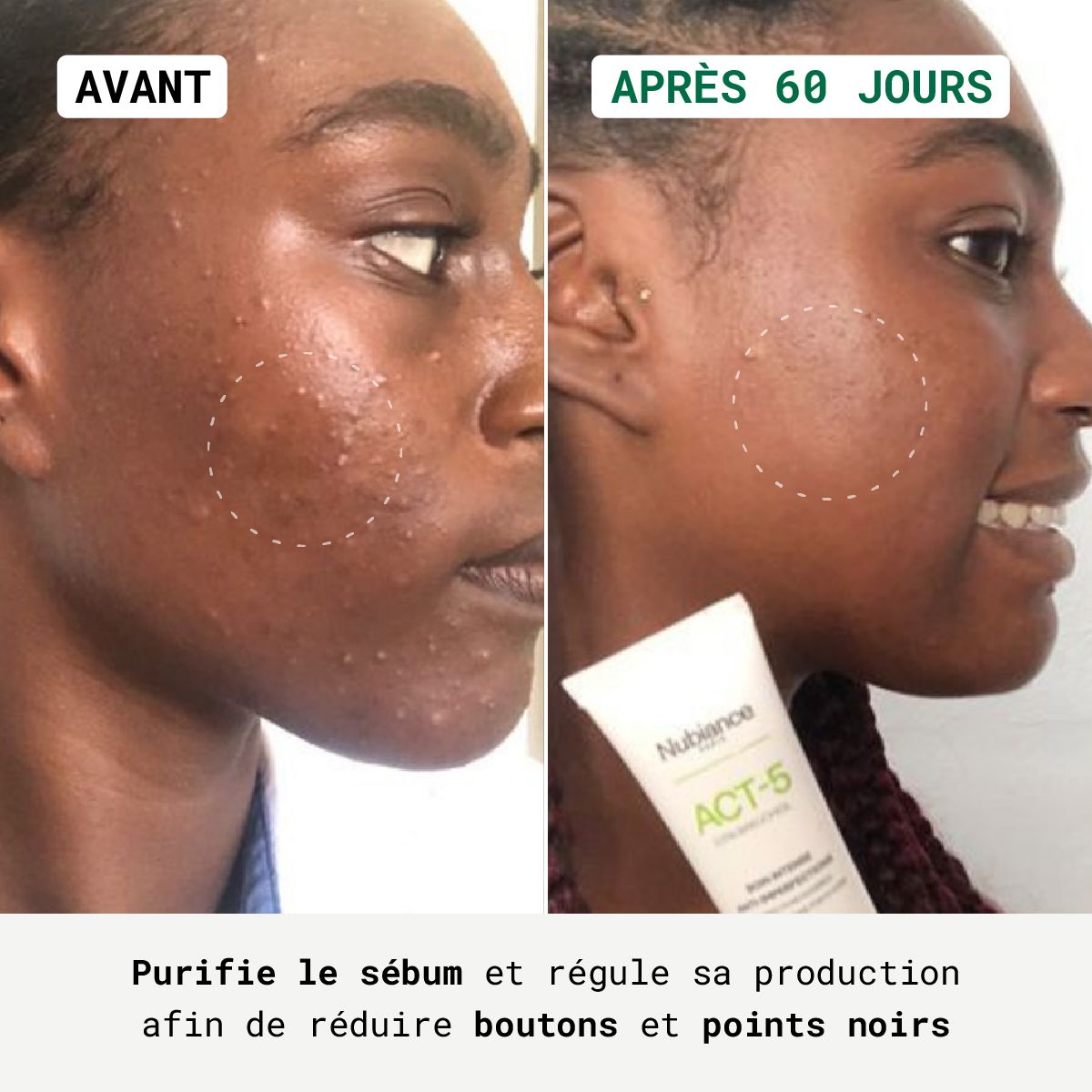 Comparaison avant-après. Visage avec imperfections, puis visage nettoyé. Tube de produit visible.