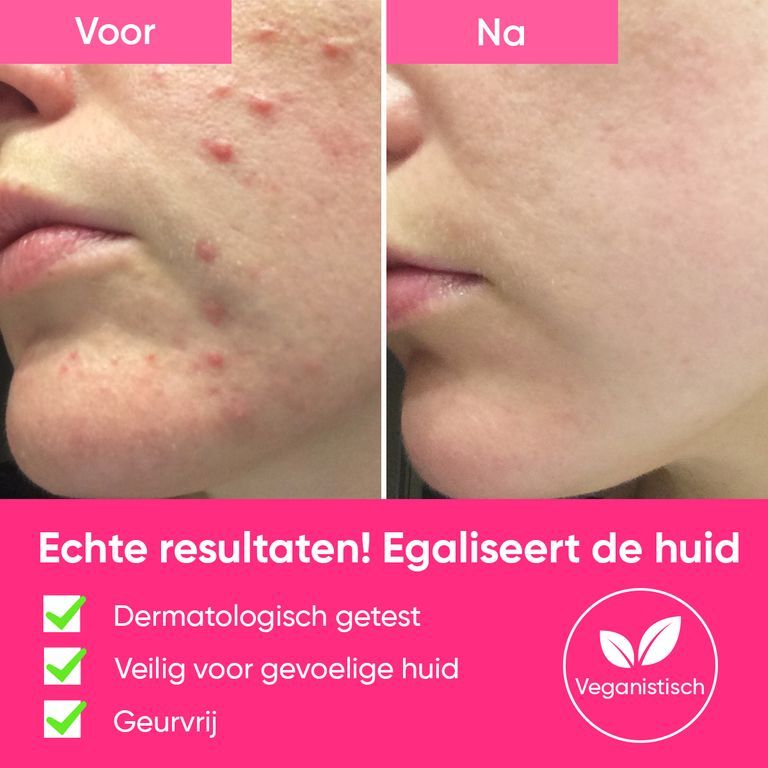 Voor-en-na vergelijking van de huid behandeld met de "Peels So Good" peeling van âme pure. Toont vermindering van onzuiverheden.