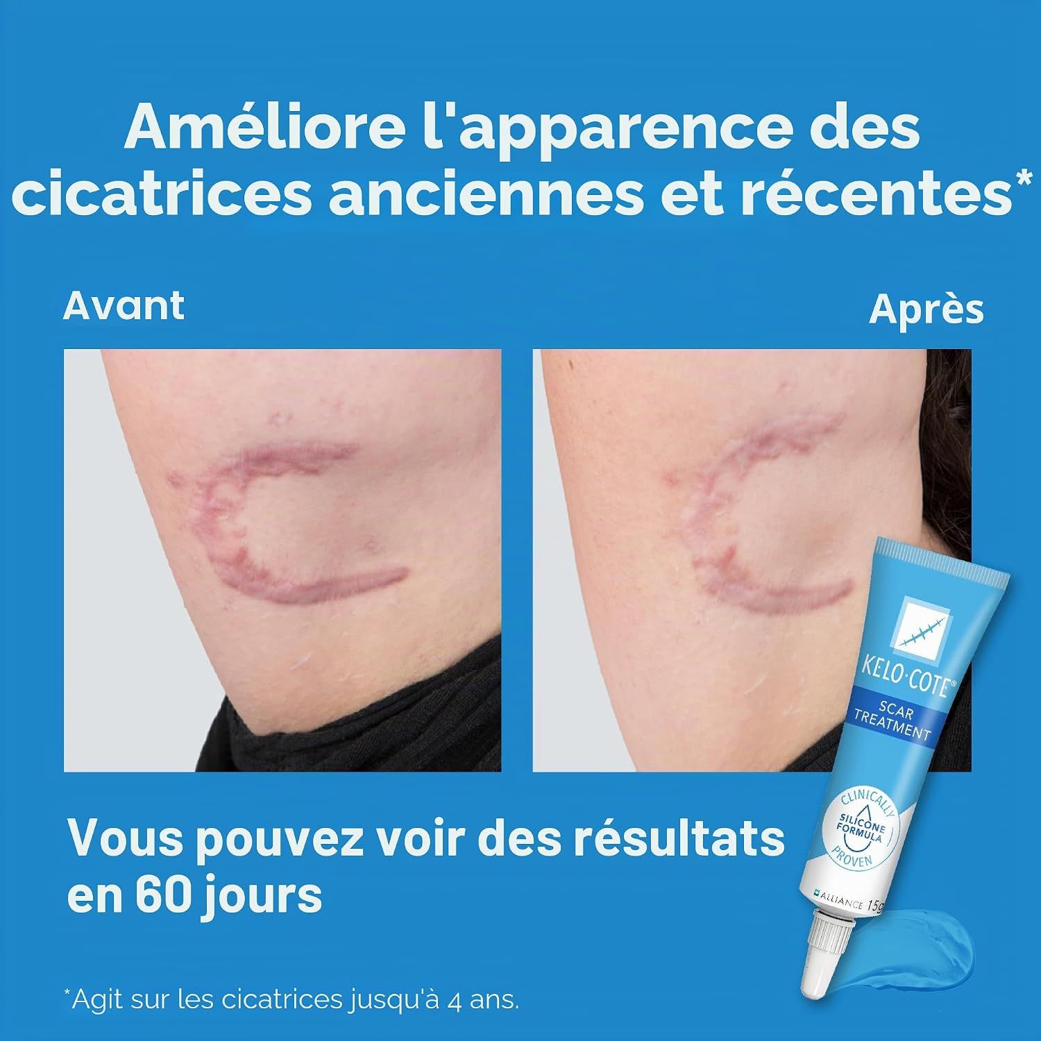 Comparaison avant-après d'une cicatrice traitée avec le gel Kelo-Cote.