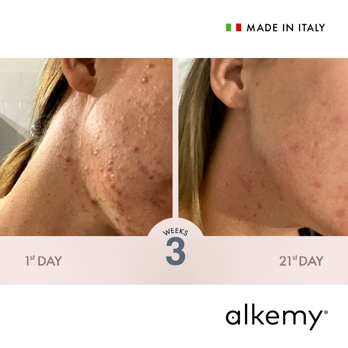 Alkemy Gezichtscrème tegen puistjes, Anti-acne behandeling, vermindert puistjes