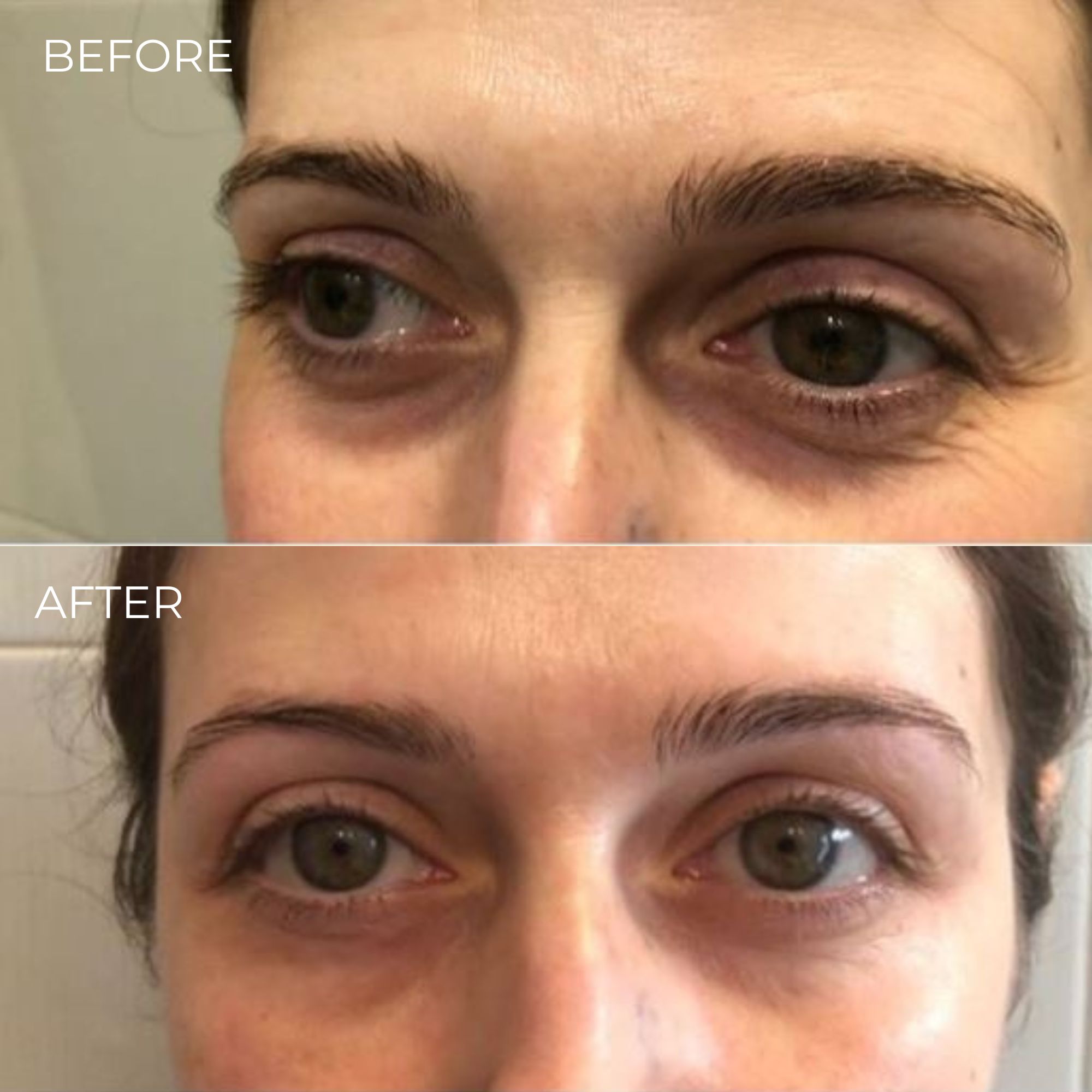 Comparaison avant-après. Contour des yeux ridé avant. Peau plus lisse après.