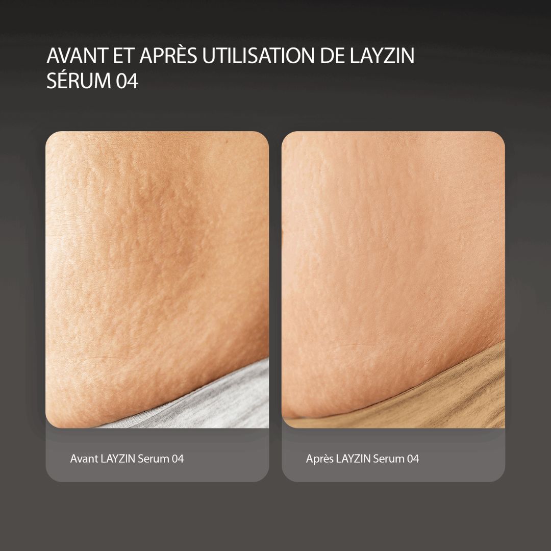 Comparaison avant-après. Peau avec vergetures. Après utilisation du sérum 04. Peau plus lisse.